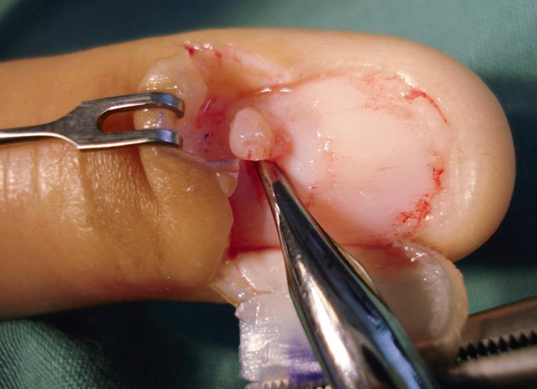 Fig. 149.10, Removal of a glomus tumor from the proximal nail matrix.