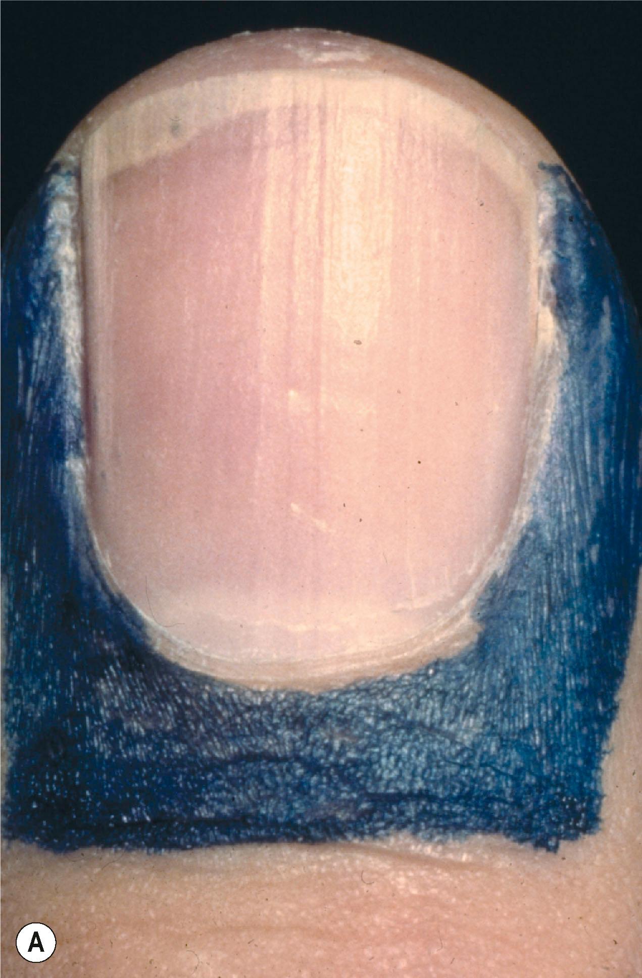 Figure 6.1, (A) The nail, the sterile and germinal matrices, and the surrounding tissue marked in blue compose the perionychium. (B) A lateral view of the nail bed showing the ventral floor (germinal matrix), the nail bed (sterile matrix), and the dorsal roof of the nail fold. (C) Histologic section of the keratinous plug at the hyponychium.