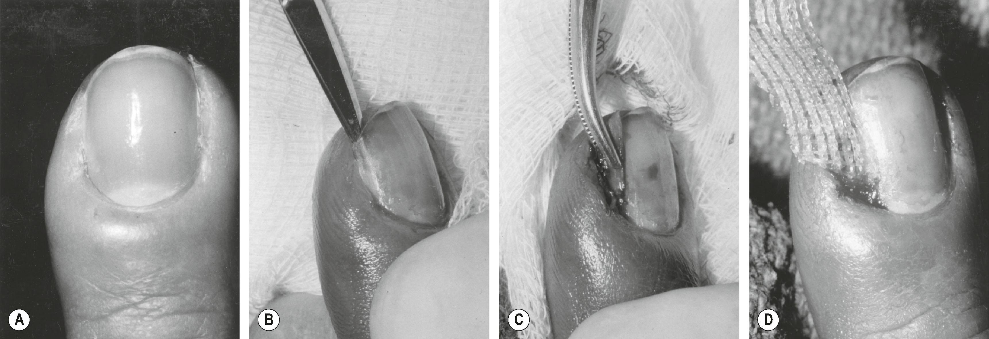 Figure 6.2, (A) A swollen, inflamed paronychium known as a paronychia. (B) The side of the nail, which is undermined by the infection, is separated from the nail bed and the lateral aspect of the dorsal roof of the nail fold. (C) This fragment of nail is removed, giving adequate drainage to the infection. (D) A piece of water-soluble gauze is placed as a drain.