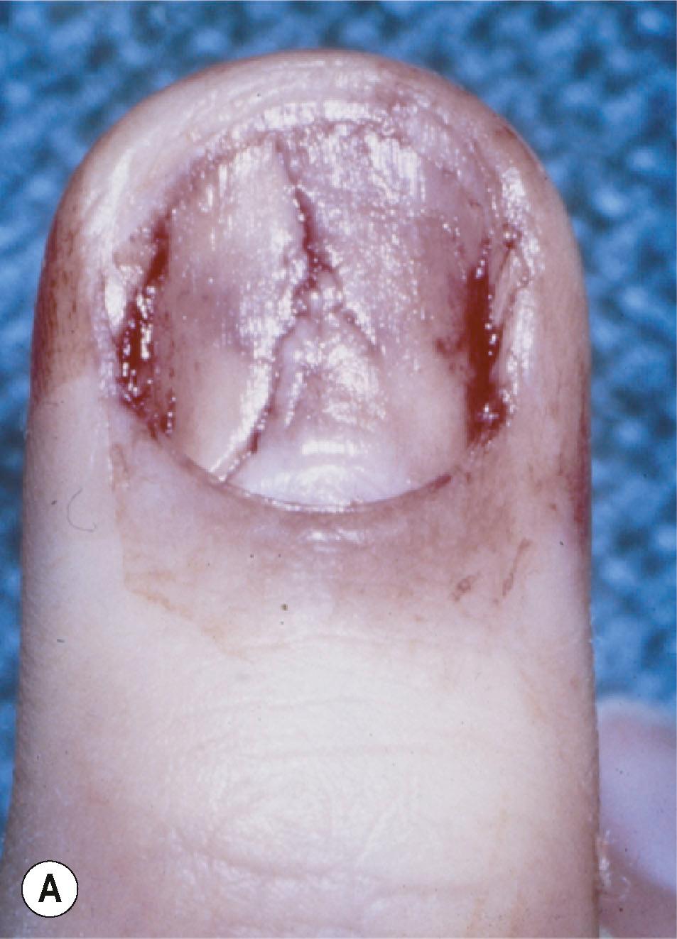 Figure 6.4, Of nail bed injuries: (A) 36% are classified as simple lacerations; (B) 27% as stellate lacerations; (C) 22% as crushing injuries of the nail bed; (D) 15% as avulsions of the germinal or sterile matrix.