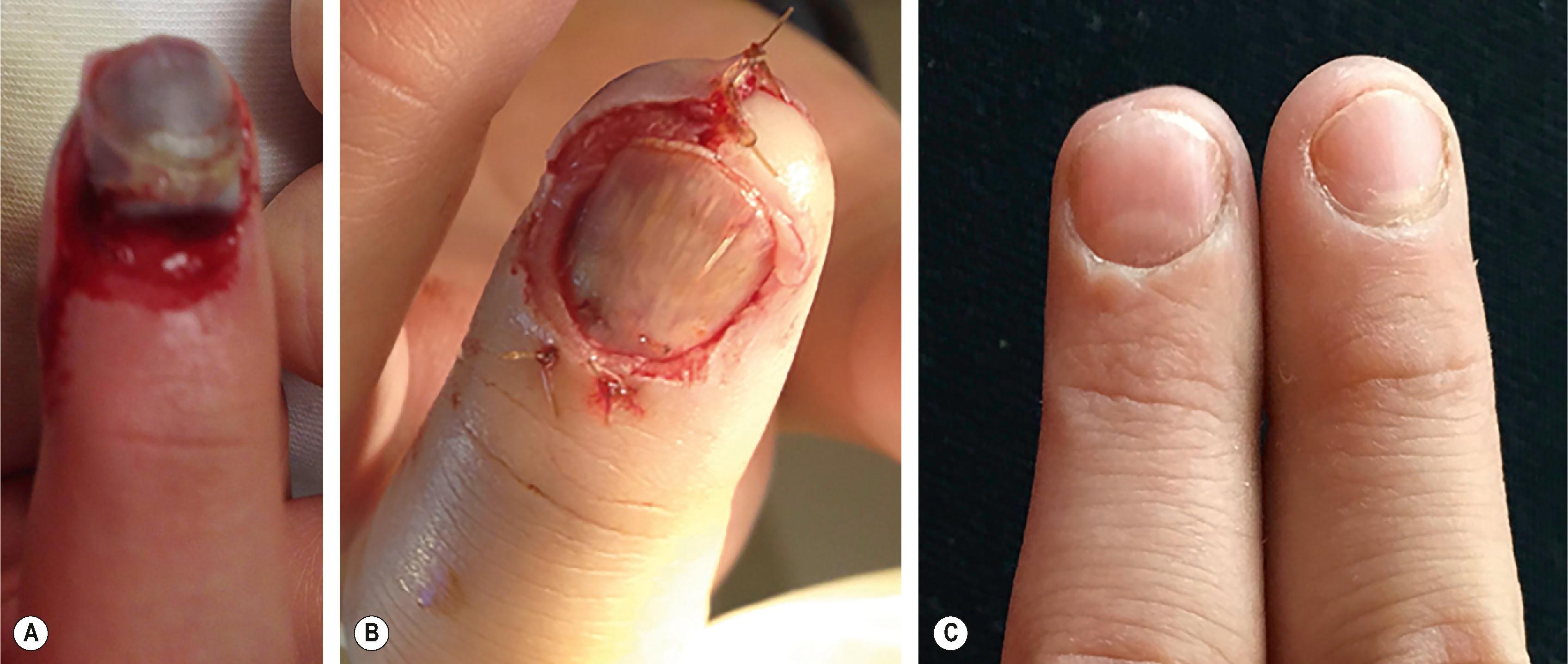 Figure 6.5, An 11-year-old male crushed his left index finger in a fence and suffered (A) an avulsion injury of the nail plate with a stellate laceration of the nail bed in the sterile matrix with an intact germinal matrix. (B) The nail was taken off with a Freer elevator, the nail bed and hyponychium were repaired, and the nail plate replaced. (C) 4 months after injury and repair (left index finger) compared to the uninjured right index fingernail.