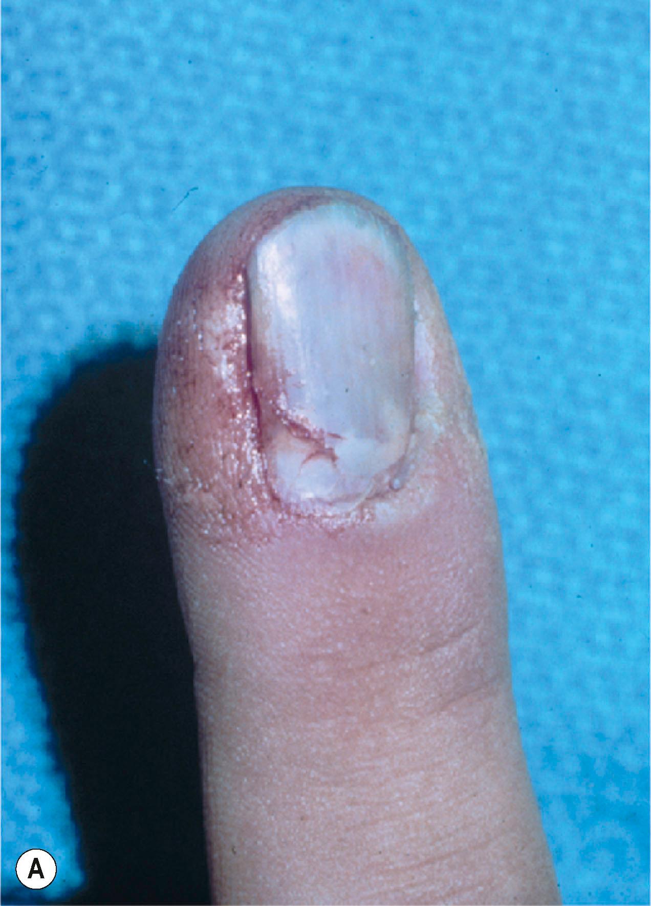 Figure 6.6, (A) When the proximal nail is flipped out of the nail fold and is lying on top of it, one must remove the nail and explore the nail bed. (B) There is almost always a nail bed laceration with stripping of the germinal matrix up with the nail or a Salter fracture of the distal phalanx. (C) The laceration must be replaced and repaired. (D) Radial incisions are made in the eponychium to access the nail fold. It is almost impossible to replace the nail in the nail fold without its total removal and then sliding it back.