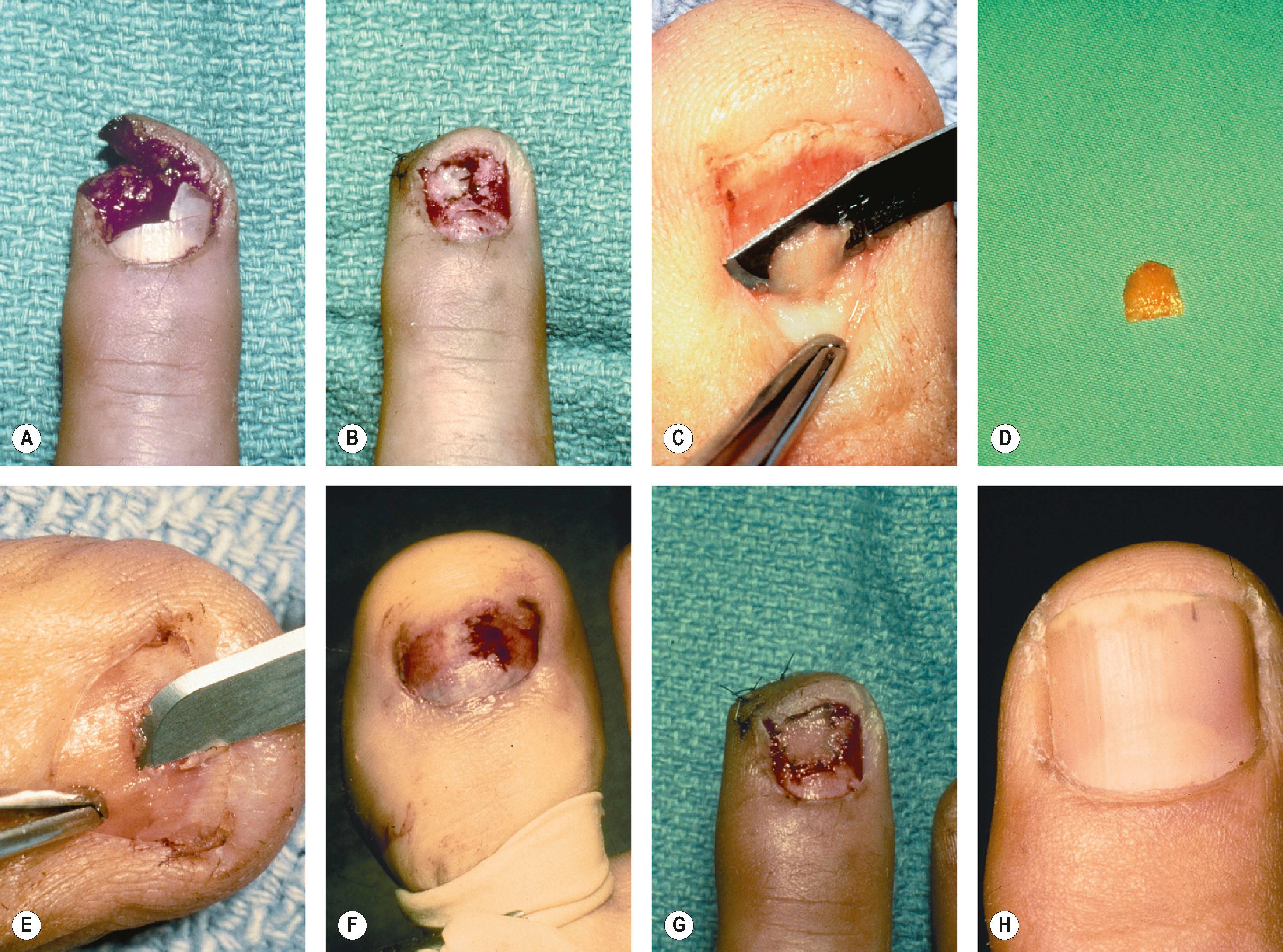 Figure 6.7, (A) A crushing injury to the tip of the finger with laceration of the surrounding skin. (B) After the skin is sutured, an area of cortex is seen. (C) A split-thickness sterile matrix graft is removed from an adjoining area on the finger or toe. Back-and-forth sawing with a scalpel blade will remove a small fragment of nail bed, which is slightly curved after the nail has been removed. The white line of the sharp edge of the blade should always be able to be seen so that the graft is not taken too thick with a resultant deformity. (D) The fragment of nail bed taken . (E) If a larger piece of nail bed graft is needed, it may be taken from proximal to distal; the tip of the knife blade is used to dissect up the split-thickness layer of nail bed. (F) The large toe after removal of the split-thickness nail bed graft. (G) A split-thickness nail bed graft is sutured into place over the periosteum without any manipulation of the cortex. (H) One year later, good regrowth of the nail and adherence are shown.