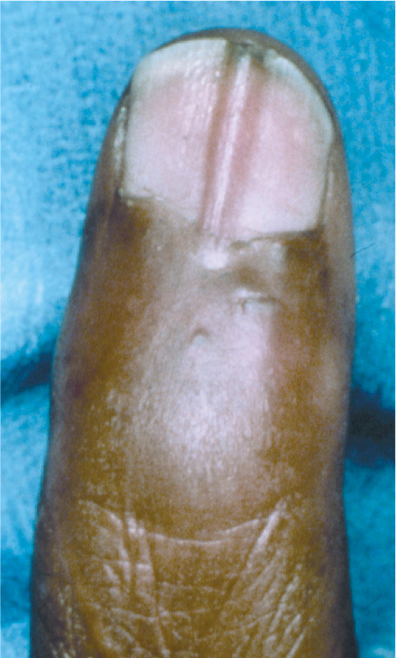 Figure 6.9, A longitudinal pin was placed to maintain fracture reduction but was between the periosteum and sterile matrix, causing scarring in the ridge.