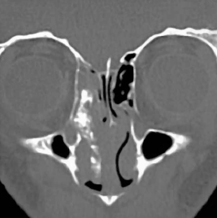 Figure 5.13, Intratumoral calcification in a right nasal cavity tumor, which is characteristic of an esthesioneuroblastoma.