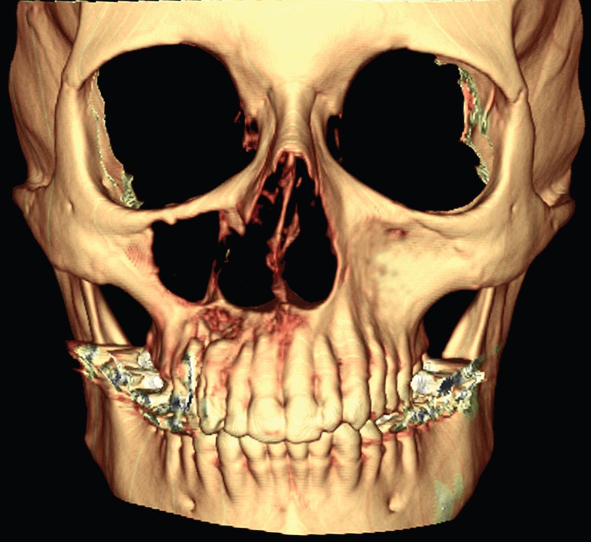 Figure 5.15, Three-dimensional reconstruction of a computed tomography scan showing the extent of bone destruction on the anterior wall of the maxilla on the right-hand side.