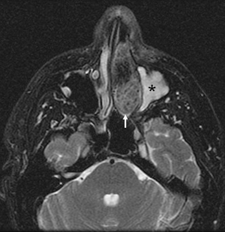 Figure 5.16, An axial T2-weighted magnetic resonance imaging of a left nasal cavity esthesioneuroblastoma ( arrow ) demonstrating high-signal postobstructive change in the left maxillary sinus (*) .