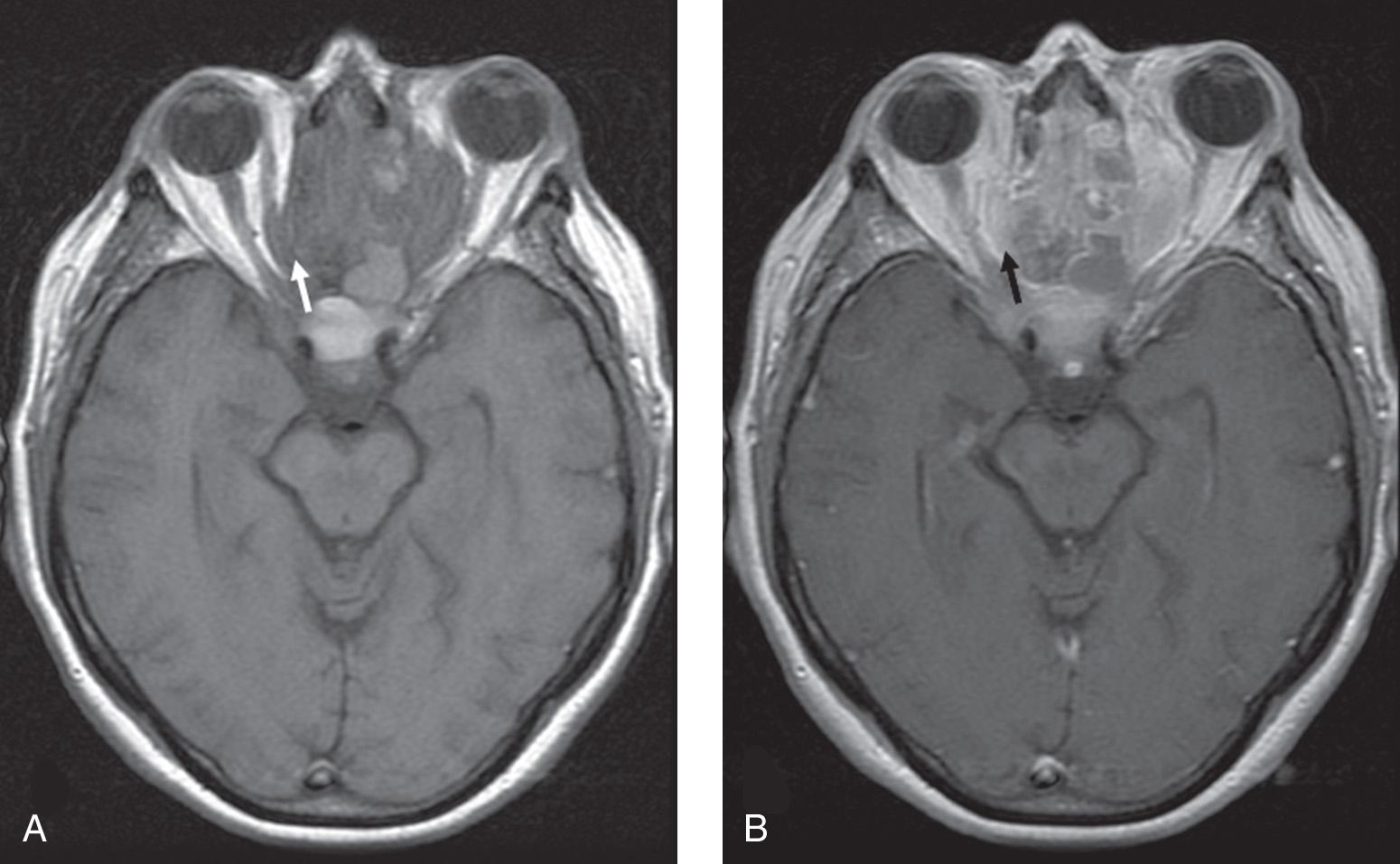 Figure 5.19, A large sinonasal tumor with bilateral intraorbital extension, on the left more than the right. Precontrast T1-weighted magnetic resonance imaging (MRI) shows obliteration of the fat plane ( white arrow ) between the medial rectus muscle and the tumor, indicating early intraorbital extension ( A ). This finding could be easily overlooked on the postcontrast T1-weighted MRI sequence without fat suppression ( B ) ( black arrow ) .
