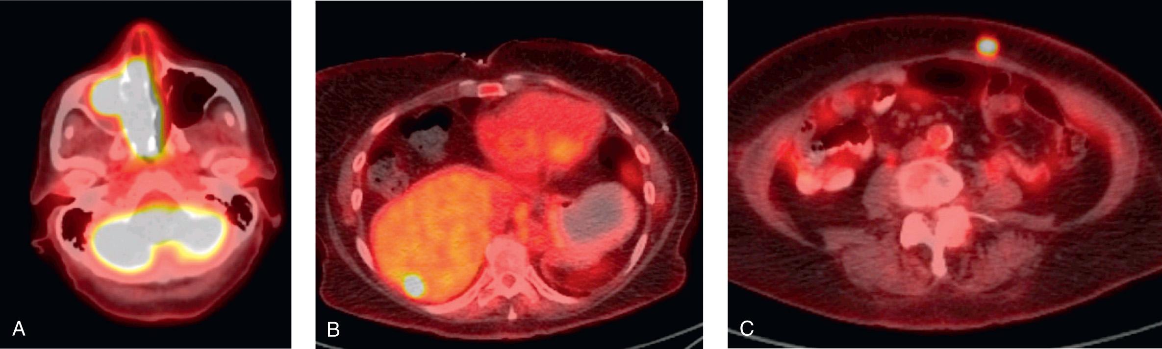 Figure 5.21, An FDG whole-body positron emission tomography (PET) scan of a patient with carcinoma of the nasopharynx showing intense FDG activity at the primary site ( A ) and distant metastases in the liver ( B ), and soft tissue of the anterior abdominal wall ( C ).