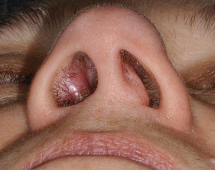 Figure 5.4, Squamous cell carcinoma of the nasal vestibule.