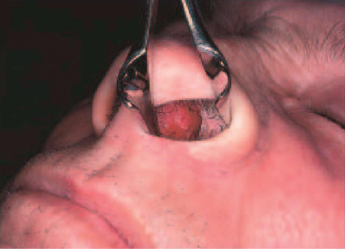 Figure 5.24, Squamous papilloma of the nasal septum.