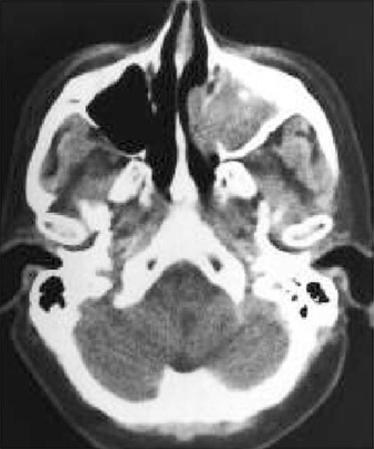 Figure 5.25, Axial view of a contrast-enhanced computed tomography scan of the sinuses showing an inverted papilloma involving the lateral wall of the nasal cavity and left maxillary sinus.