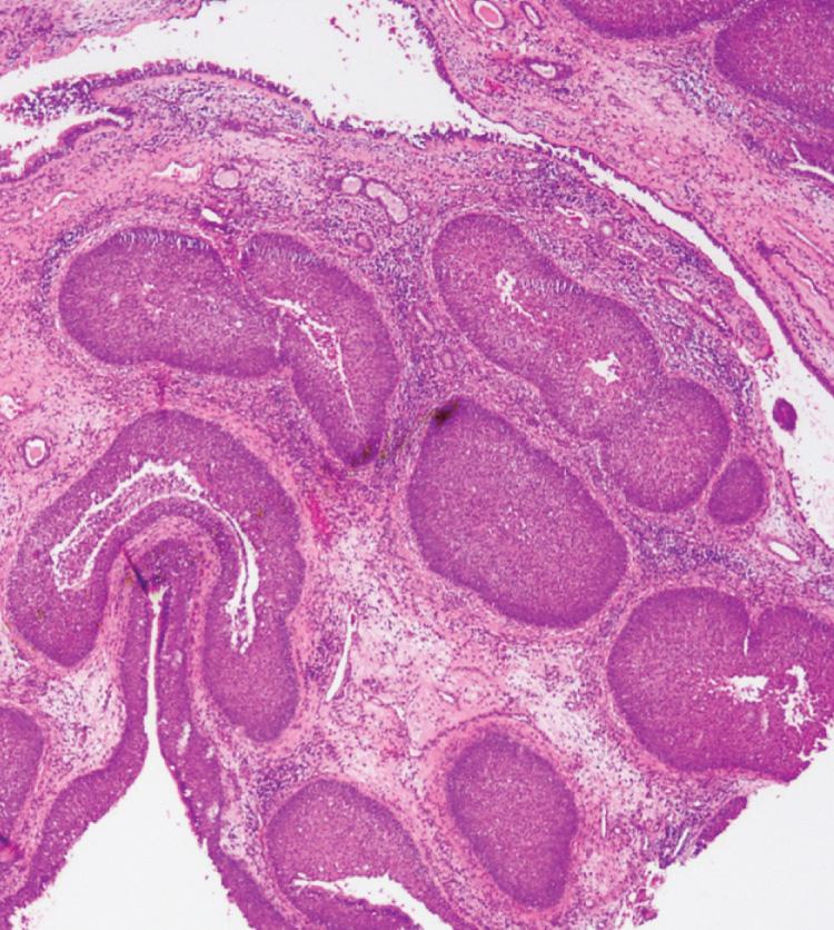 Figure 5.26, The histomicrographic appearance of an inverted papilloma of the lateral nasal wall (hematoxylin and eosin ×40).