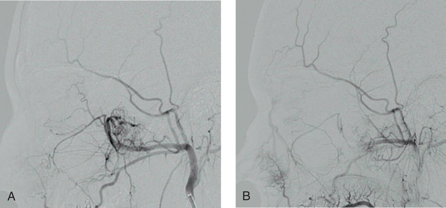 Figure 5.28, Selective external carotid angiogram showing a highly vascular tumor ( A ). Following successful embolization, most of the blood supply of the tumor is cut off ( B ).