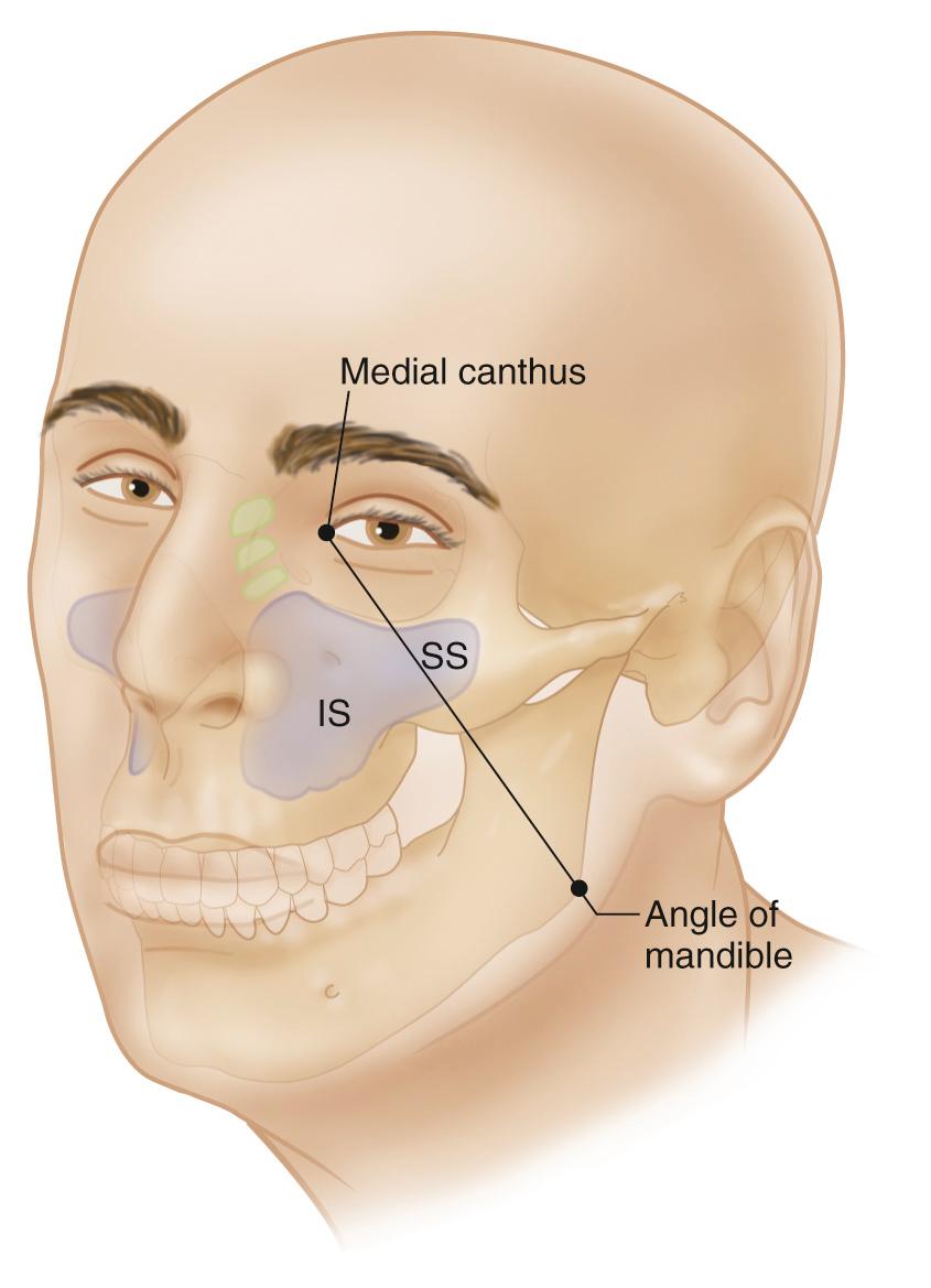 Figure 5.29, The plane described by Öhngren's line divides the region of the nasal cavity and maxillary antrum into infrastructure (IS) and suprastructure (SS) .