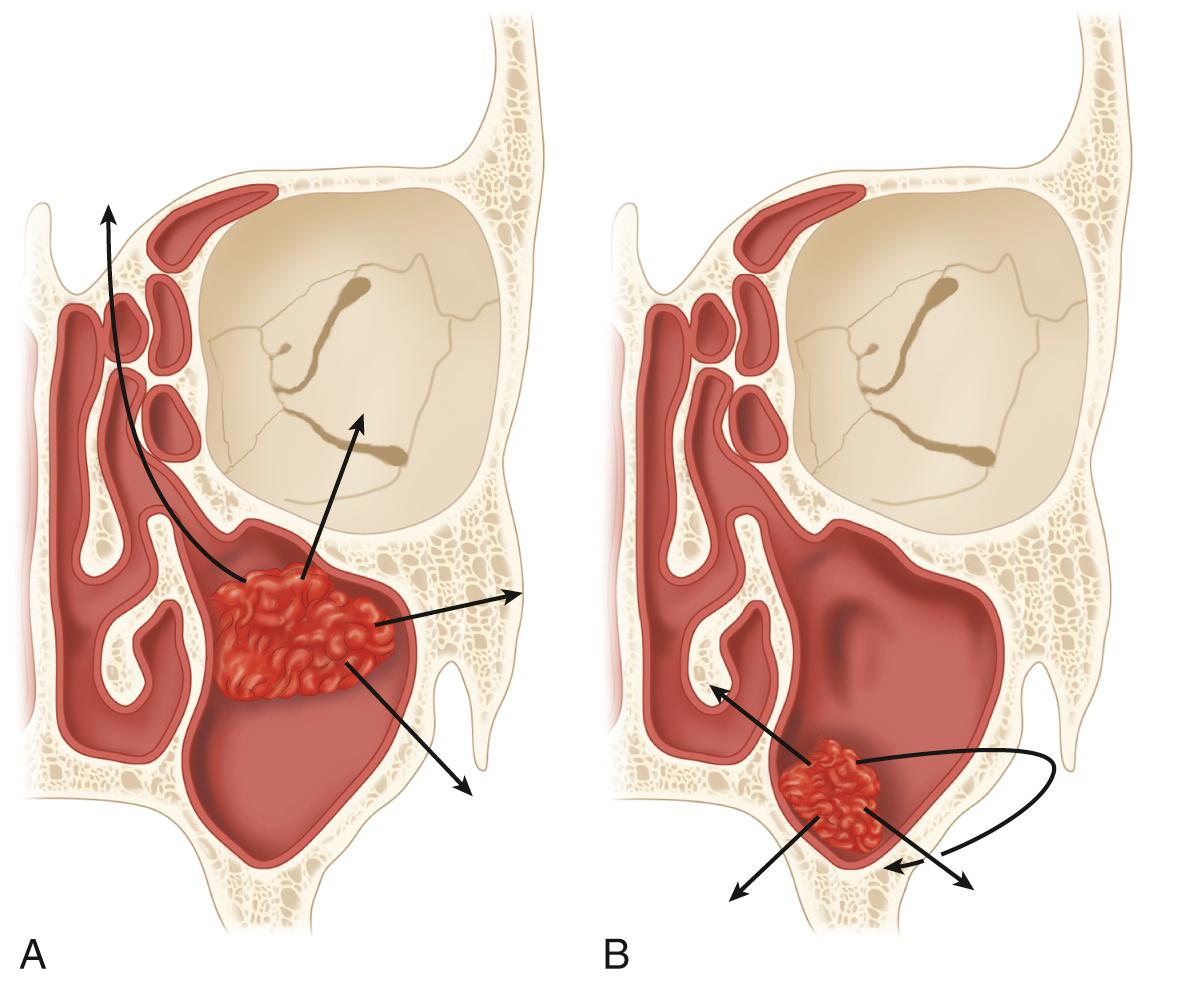 Figure 5.30, Routes of spread of tumors of the maxillary antrum. A , Suprastructure. B , Infrastructure.