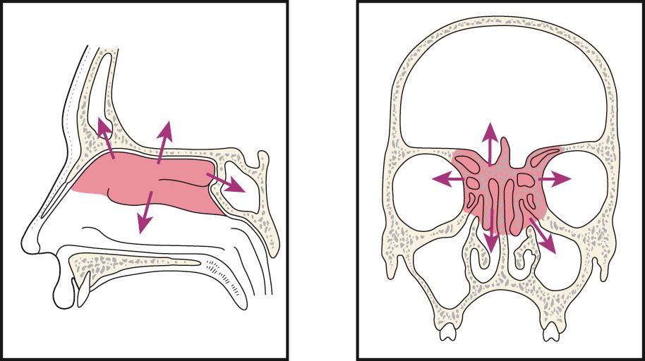 Figure 5.32, Routes of spread of tumors of the ethmoid cavity.