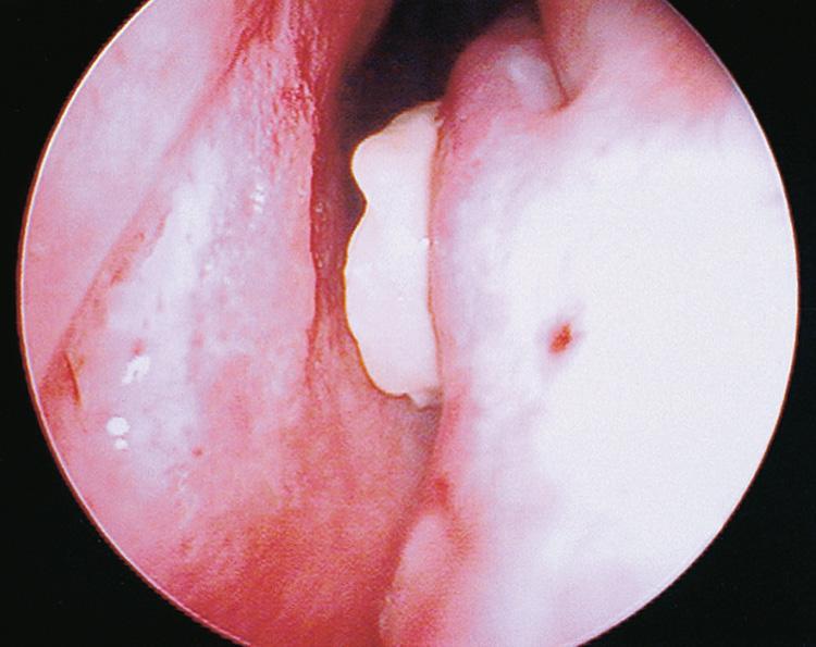 Figure 5.5, Sinonasal benign polyp at the middle meatus.