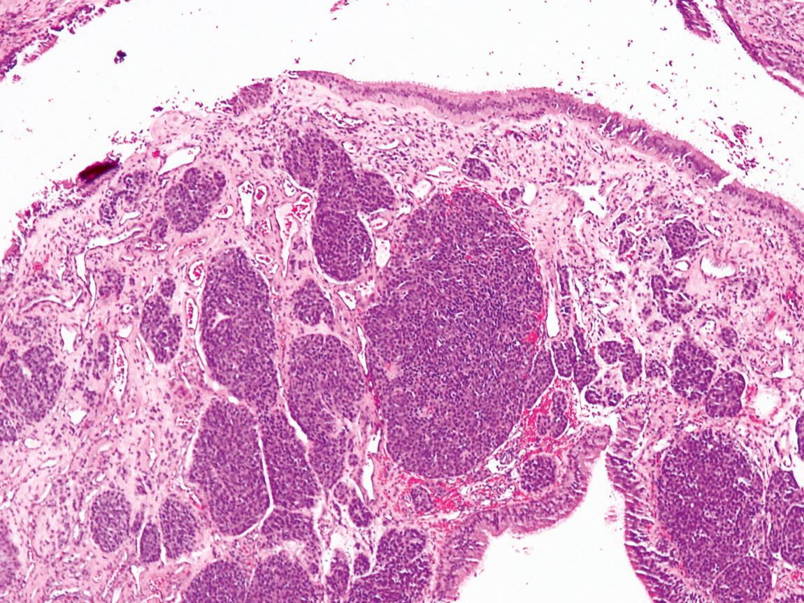 Figure 5.34, A histomicrograph of a low-grade olfactory neuroblastoma showing small round cells proliferating in a lobular, nested pattern beneath intact respiratory epithelium.