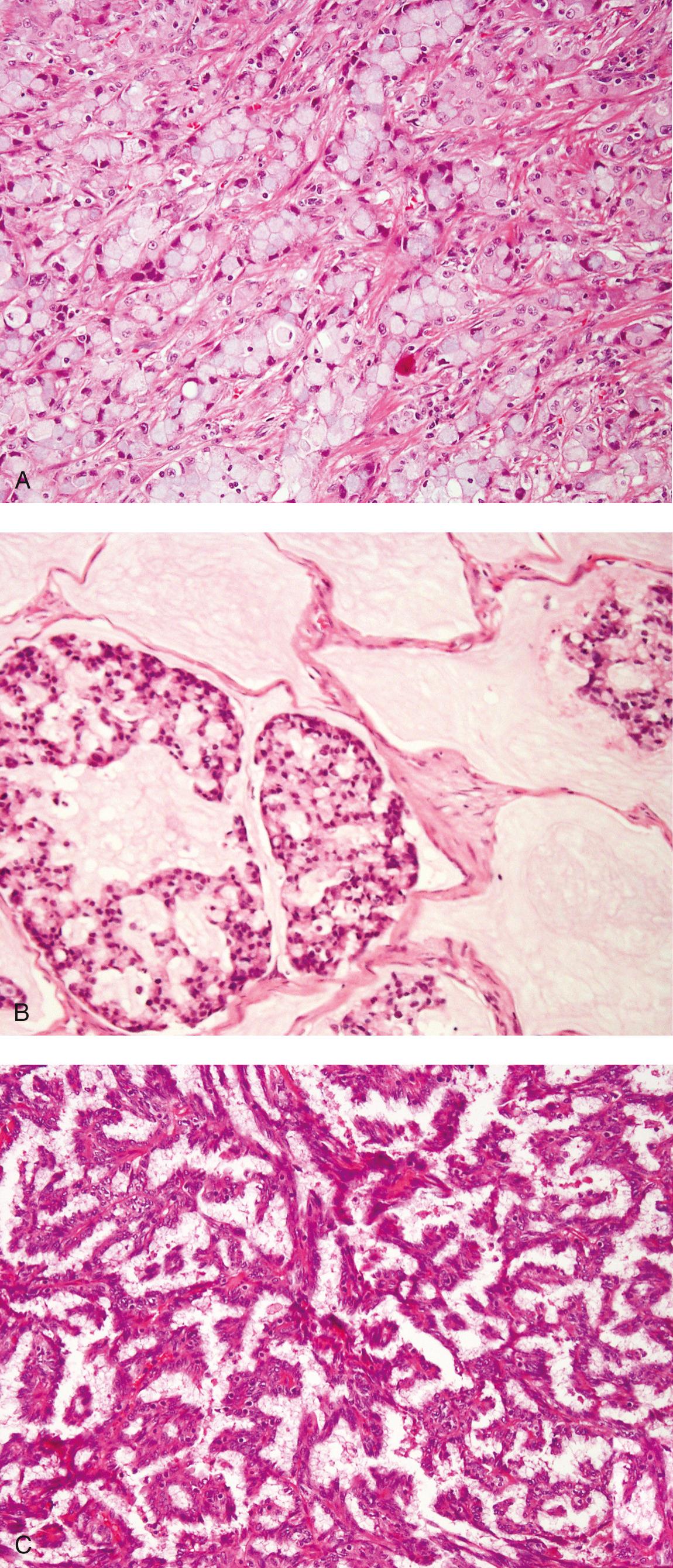 Figure 5.35, Photomicrographs of adenocarcinomas of minor salivary gland origin. A , Intestinal-type sinonasal adenocarcinoma with signet ring cells. B , Mucinous intestinal-type adenocarcinoma with neoplastic glands floating within pools of mucin. C, Nonintestinal sinonasal adenocarcinoma with papillary structures and fibrovascular cores.