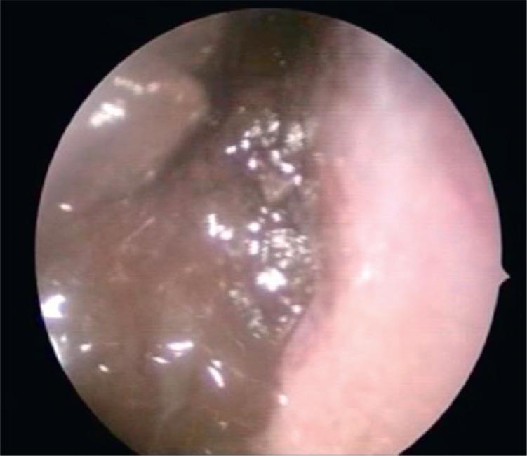 Figure 5.7, Mucosal melanoma of the ethmoid.