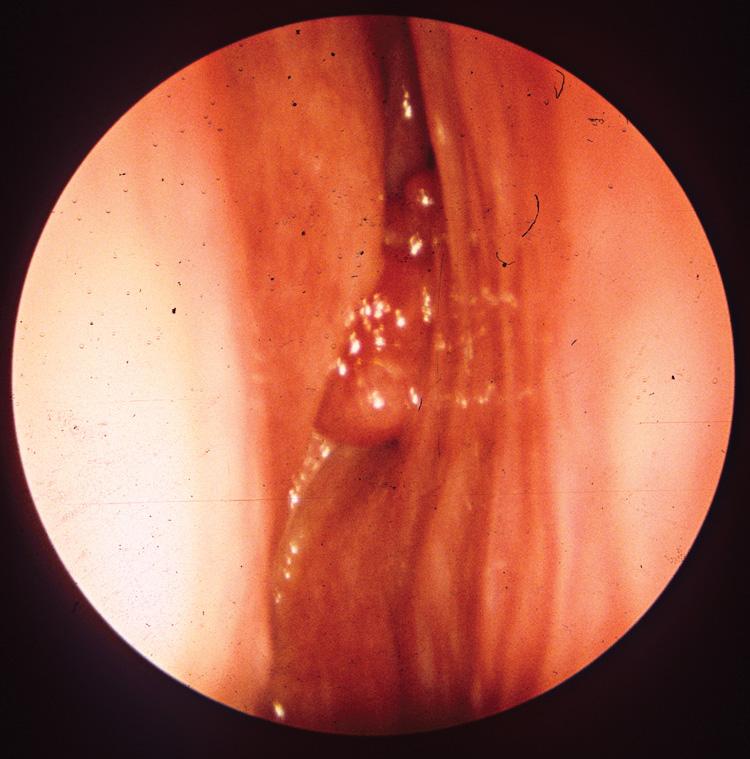 Figure 5.9, An esthesioneuroblastoma.