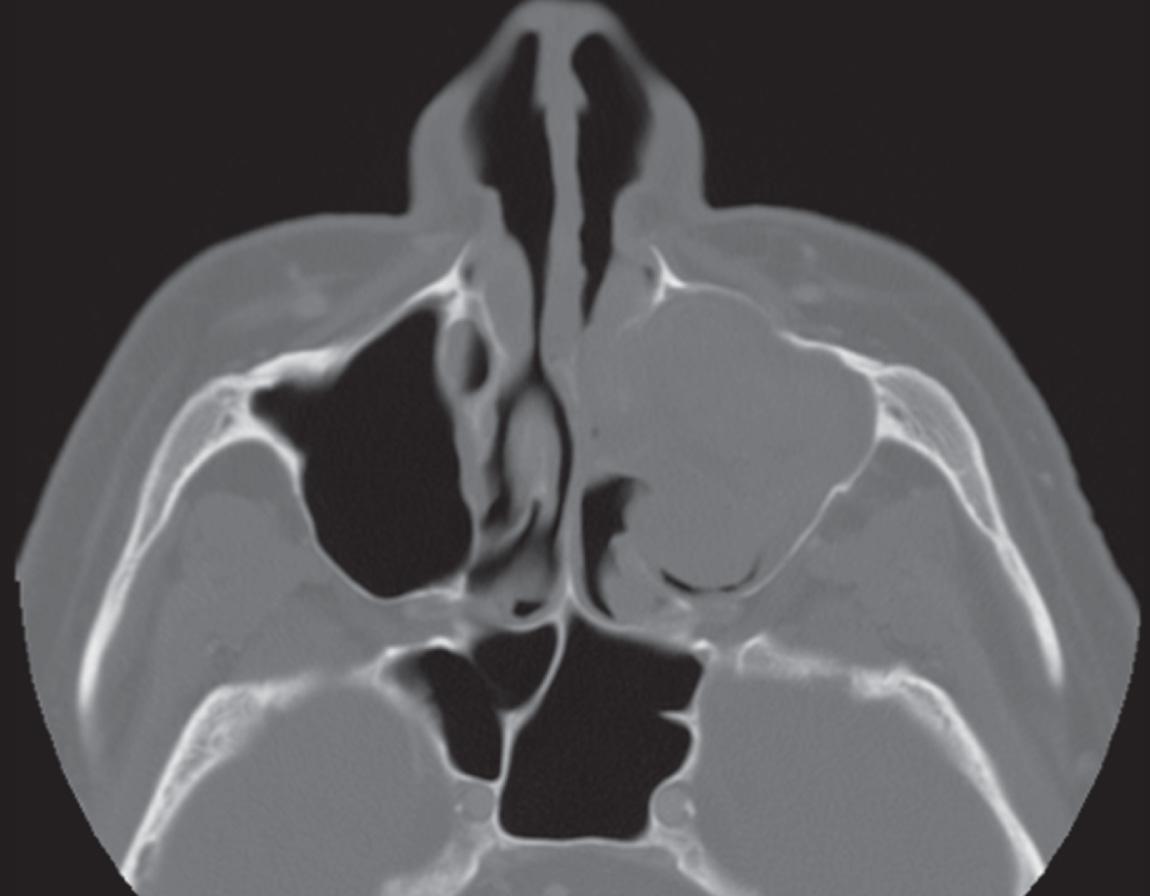 Figure 5.12, Computed tomography showing expansion and remodeling of bone around a left maxillary sinus tumor.