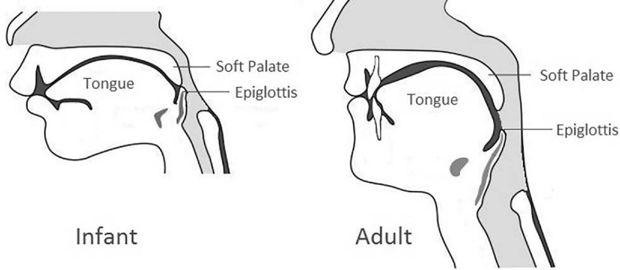 Fig. 70.1, Anatomic Comparison Between the Infant and Adult Airway.