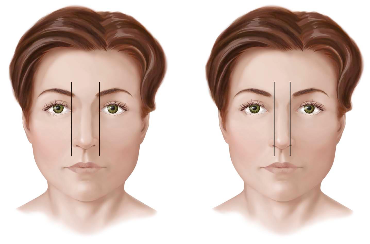 Figure 10-1, A, The nasal base width should be equal to the intercanthal width. B, The width of the of the lateral bony walls should be 75% of the width of the nasal base.