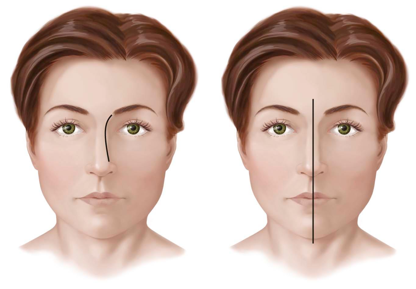 Figure 10-2, A, The brow-tip aesthetic line should follow a gentle curve from the medial brow to nasal tip. B, Nasal deviation can be assessed by drawing a vertical line from the midglabella to the menton.