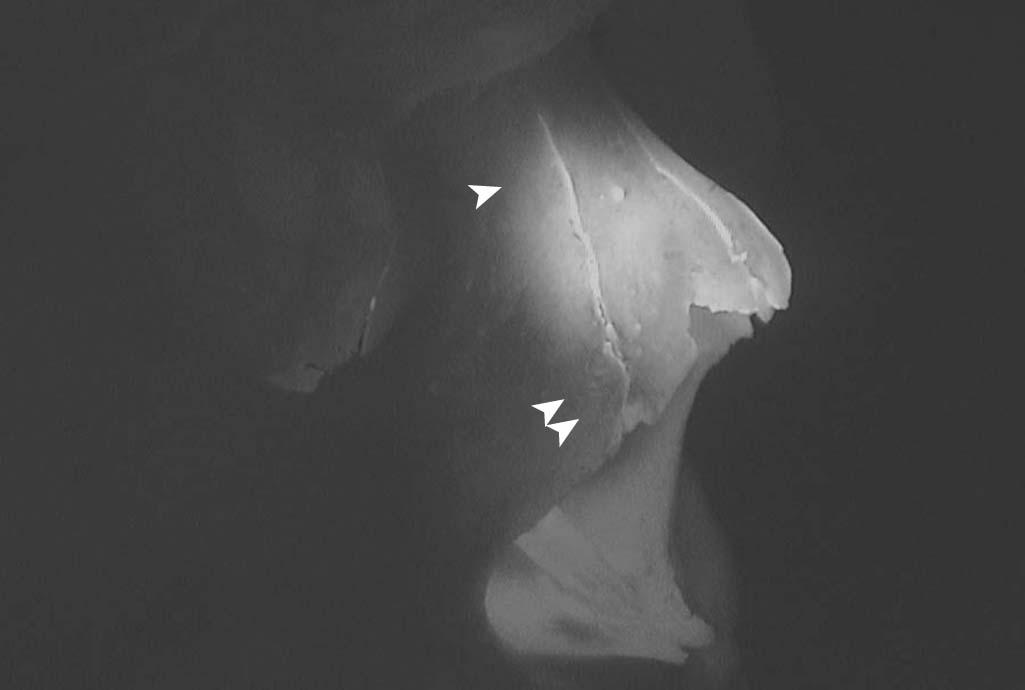 Figure 10-3, Transillumination of the skull reveals the variable thickness of the nasal bones, which are mobilized with osteotomies in rhinoplasty. The nasal bones are thicker superiorly ( arrowhead ) and thinner inferiorly ( double arrowheads ).