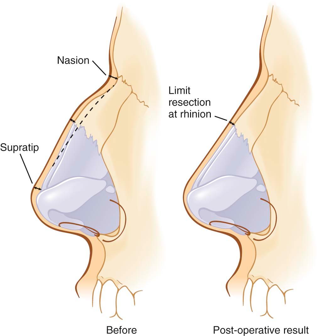 Figure 10-4, A, The skin is thicker at the nasion and supratip and thinner at the rhinion. Dorsal resection limiting resection at the rhinion will result in a straighter postoperative profile. B, A more aggressive dorsal resection that creates a straight orientation of the underlying cartilaginoskeletal framework will give a concave postoperative profile appearance due to the difference in thickness of the overlying skin.