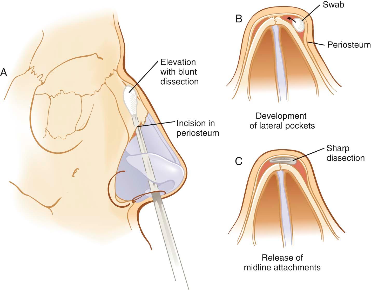 Figure 10-5, Elevation of the periosteal flap is begun with a Cottle elevator, and may be continued to the nasofrontal suture using the same instrument or a periosteal elevator. Care should be taken to preserve the lateral periosteal attachments as this will help reduce the risk of a flail bone.