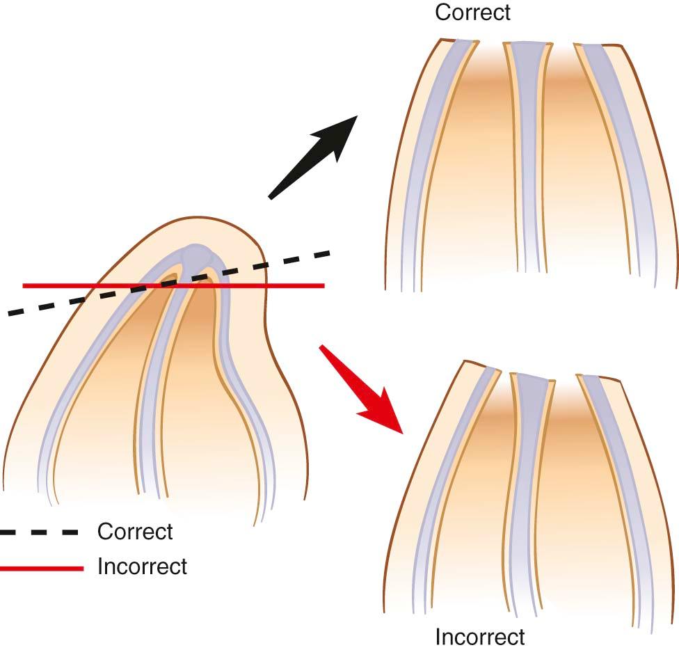 Figure 10-6, A, In crooked noses, the dorsal hump resection should be performed in a tangential plane by removing more bone and cartilage on the convex side ( dotted line ) rather than approaching it with a straight perpendicular cut ( solid line ). B, Illustration of the position and height of nasal bones after hump removal and osteotomies are performed to straighten the bone. Note. If the tangential plane was taken, the nasal bones will be more symmetric.