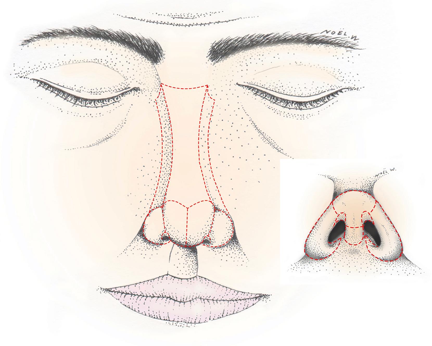 Fig. 30.2, Esthetic subunits of the nose: 1 dorsum, 2 sidewalls, 1 tip (divided into two hemi-tips), 2 alar lobules, 2 soft triangles, 1 columella.