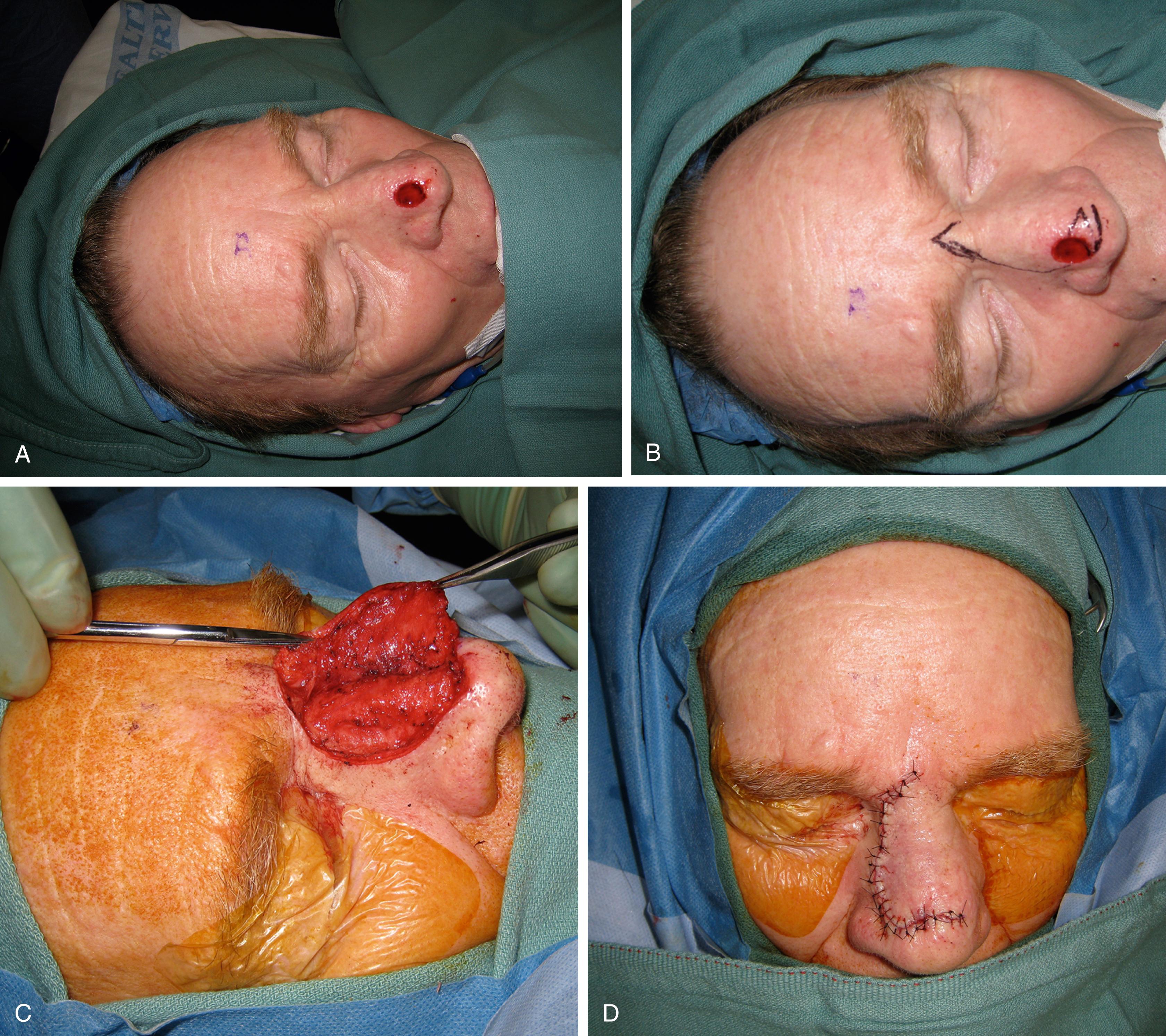 Fig. 30.3, Dorsal nasal flap lower third of the nose (classic indication): (A) distal nasal defect; (B) flap design; (C) flap elevated to periosteum; (D) flap final inset.