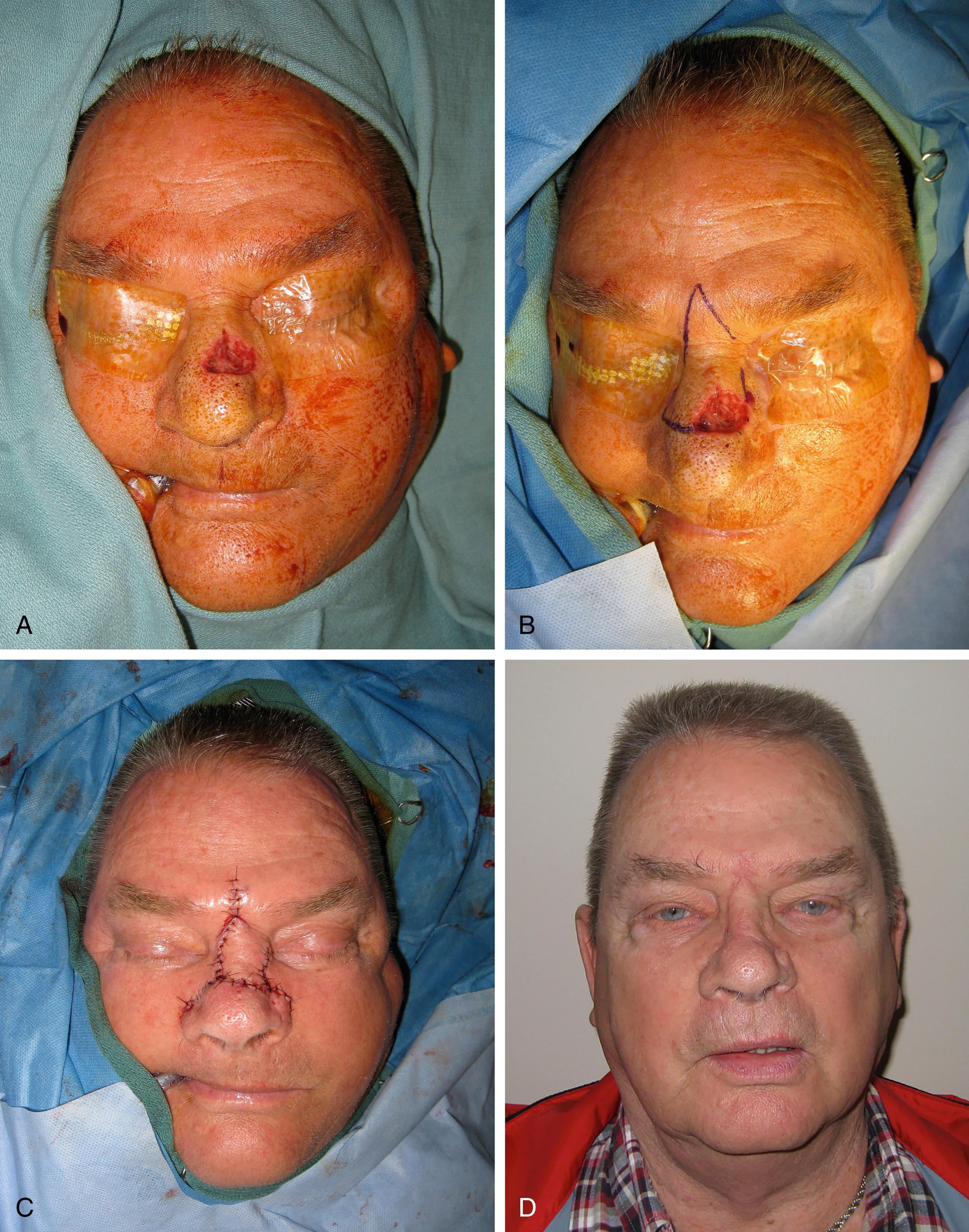 Fig. 30.4, Dorsal nasal flap for upper third defect: (A) initial defect; (B) flap design; (C) flap inset; (D) final result.