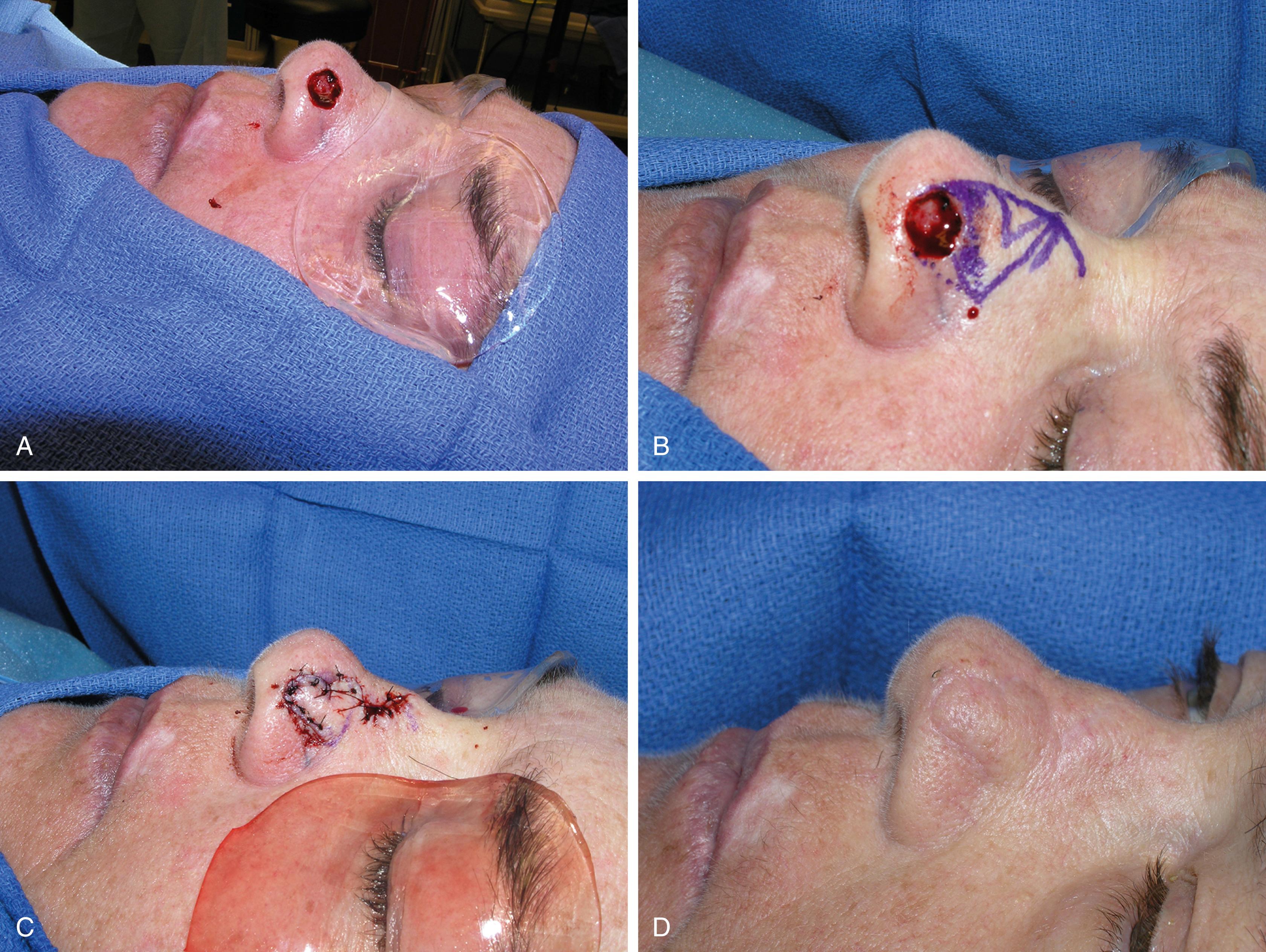 Fig. 30.5, Bilobed flap: (A) initial defect; (B) flap design; (C) flap inset; (D) final result.