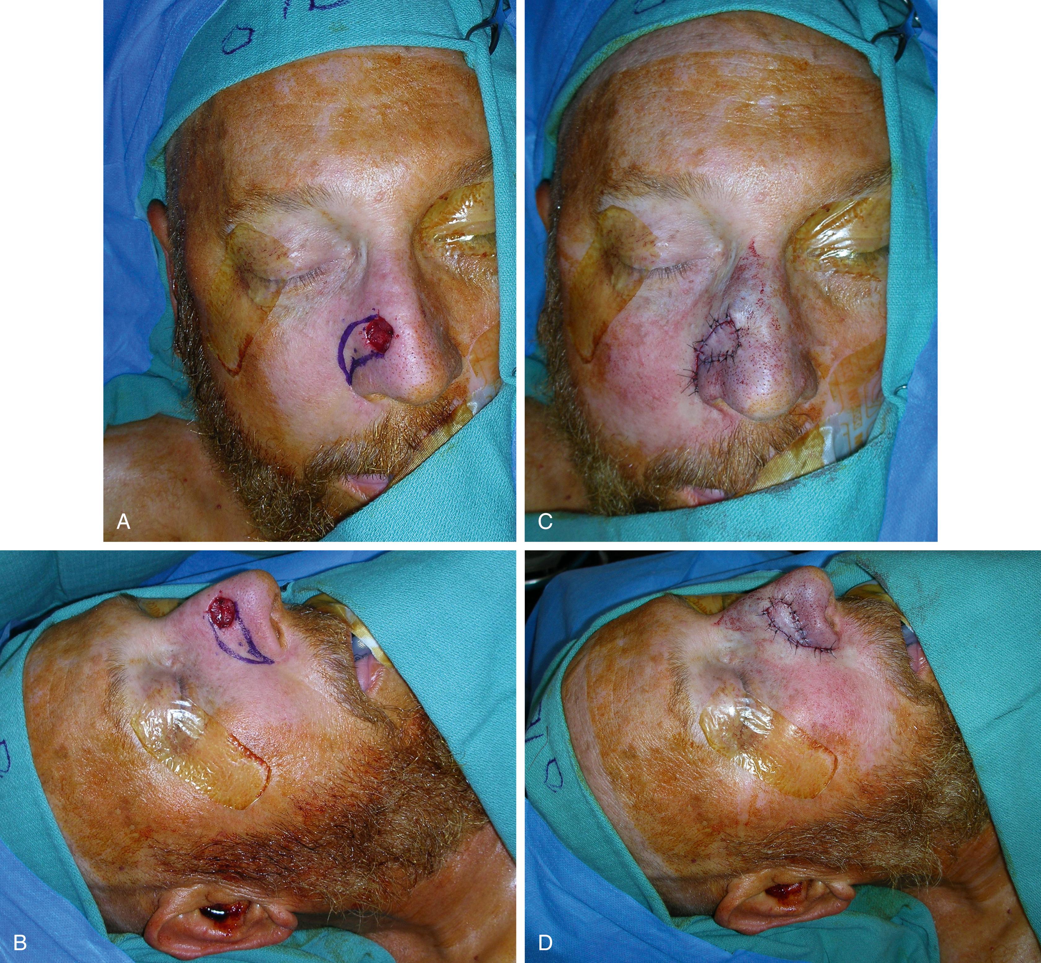 Fig. 30.6, V–Y nasal flap: (A) flap design frontal view; (B) flap design lateral view; (C) flap inset frontal view; (D) flap inset lateral view.