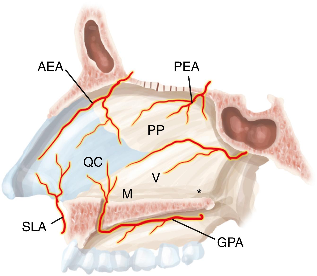 Fig. 96.1, Anatomy of the nasal septum. Quadrangular cartilage (QC), perpendicular plate of the ethmoid bone (PP), vomer (V), maxillary bone (M), palatine bone (∗), superior labial artery (SLA), anterior ethmoid artery (AEA), posterior ethmoid artery (PEA), posterior nasal septal artery (PNA), and greater palatine artery (GPA).