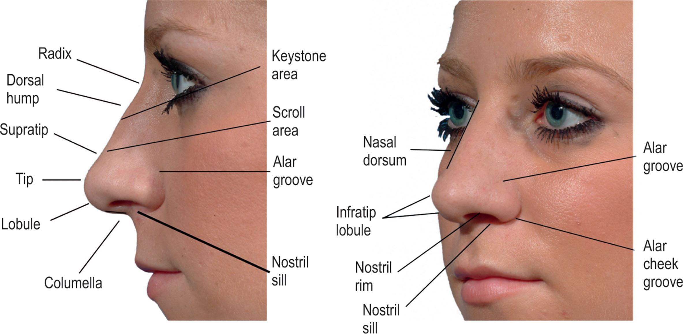 Figure 18.1, Standardized terminology of external nasal landmarks exists, which facilitates a discussion of proportionate and disproportionate nasal aesthetics. These landmarks, essentially reference points of nasal topography, often relate directly to the shape and relationship of underlying structures.