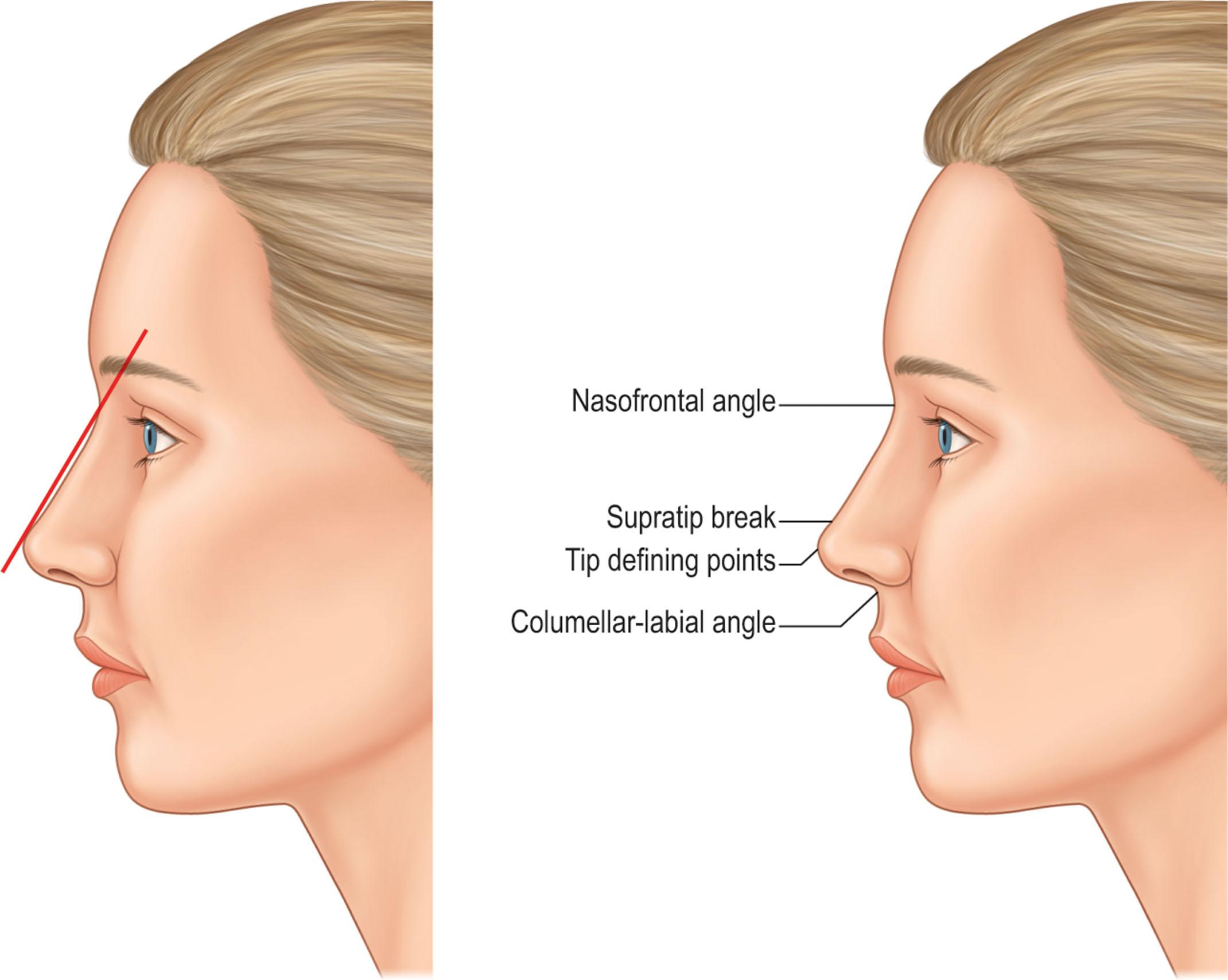 Figure 18.11, A line drawn from radix to nasal tip helps to analyze dorsal aesthetics. The dorsum is located behind this line, and the steepest curve occurs just cephalad to the nasal tip. This supratip break is determined by the relationship between tip projection and septal and upper lateral (middle vault) height.