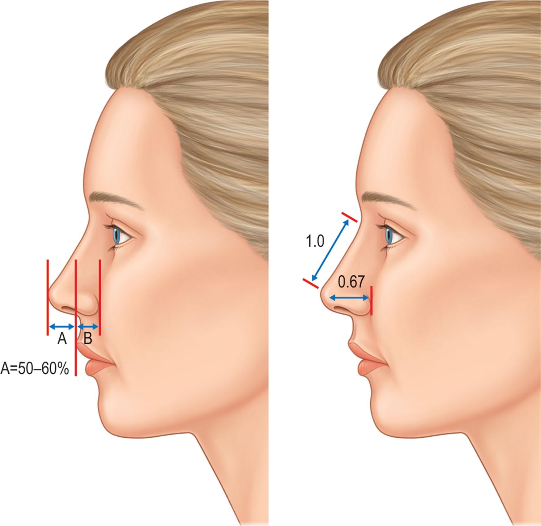 Figure 18.13, Tip projection can be analyzed by three techniques, either relative to the nostril or relative to nasal length. Here, two methods are shown.