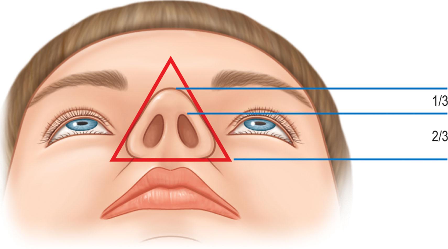 Figure 18.14, Tip projection is determined here, relative to nostril position. In addition, the basal view should reveal the nose as an equilateral triangle.