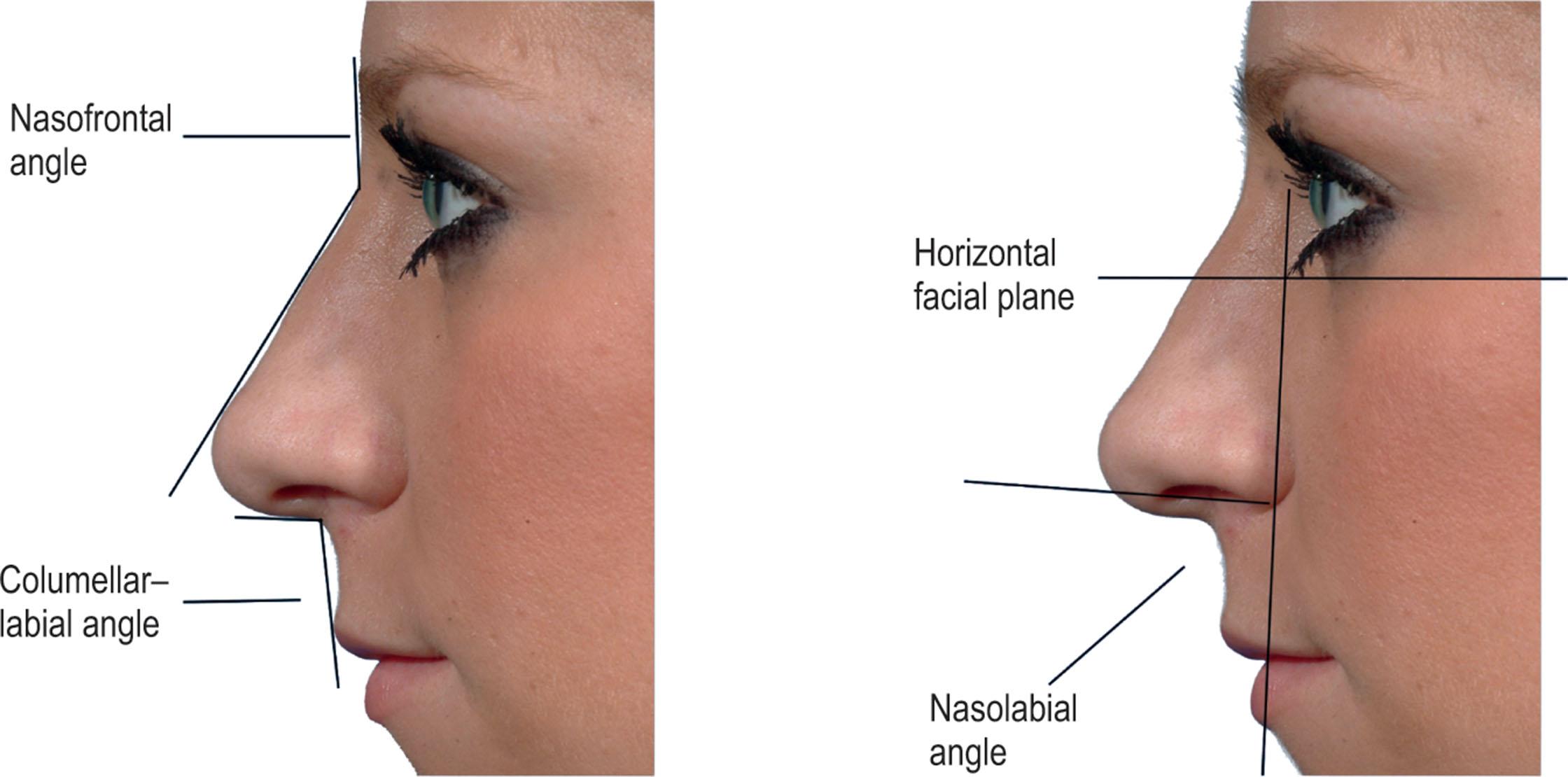 Figure 18.2, Angular measurements assess multiple factors, such as nasal length, alar base position, and lip aesthetics.