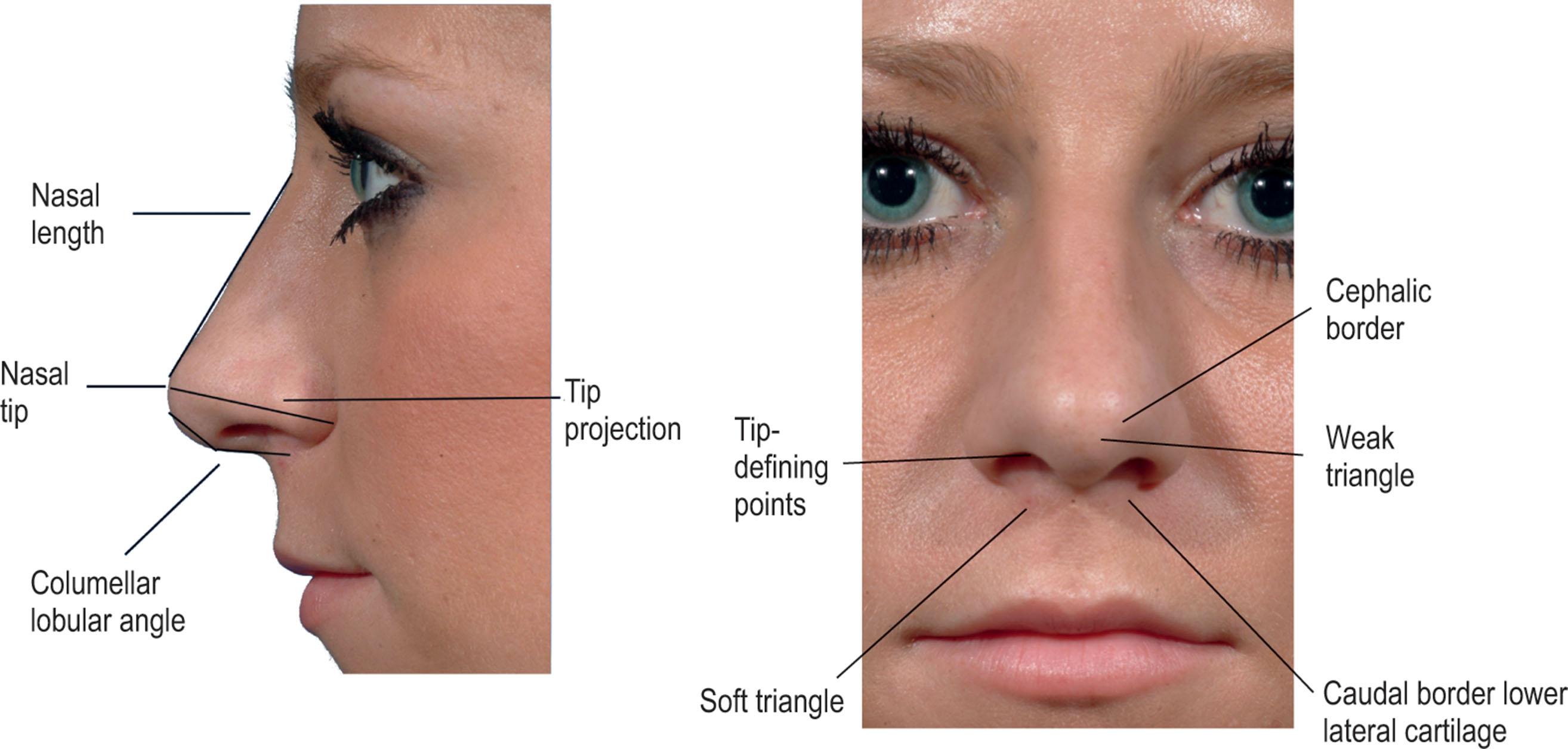 Figure 18.3, Tip projection, a critical measurement in preoperative analysis, is defined as the maximal distance from alar base to the nasal tip.