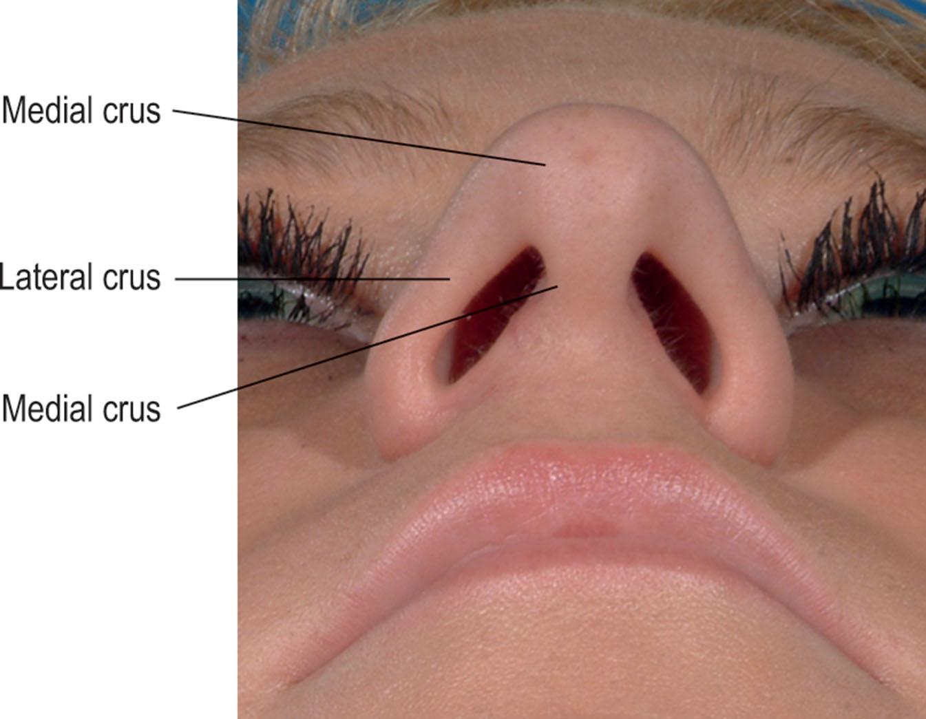 Figure 18.4, The lower lateral cartilages, comprising the lower third nasal vault, have three defined segments. These segments are determined by where the lower lateral cartilages display marked changes in curvature.