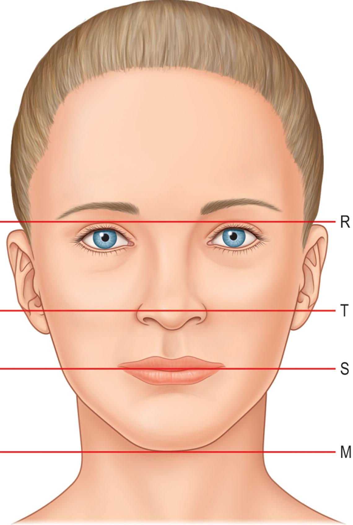 Figure 18.5, General guidelines exist to assess nasal aesthetics in relation to the rest of the face. One guideline suggests that nasal length is equal to lower facial height. M, Menton; R, radix; S, stomium; T, tip.