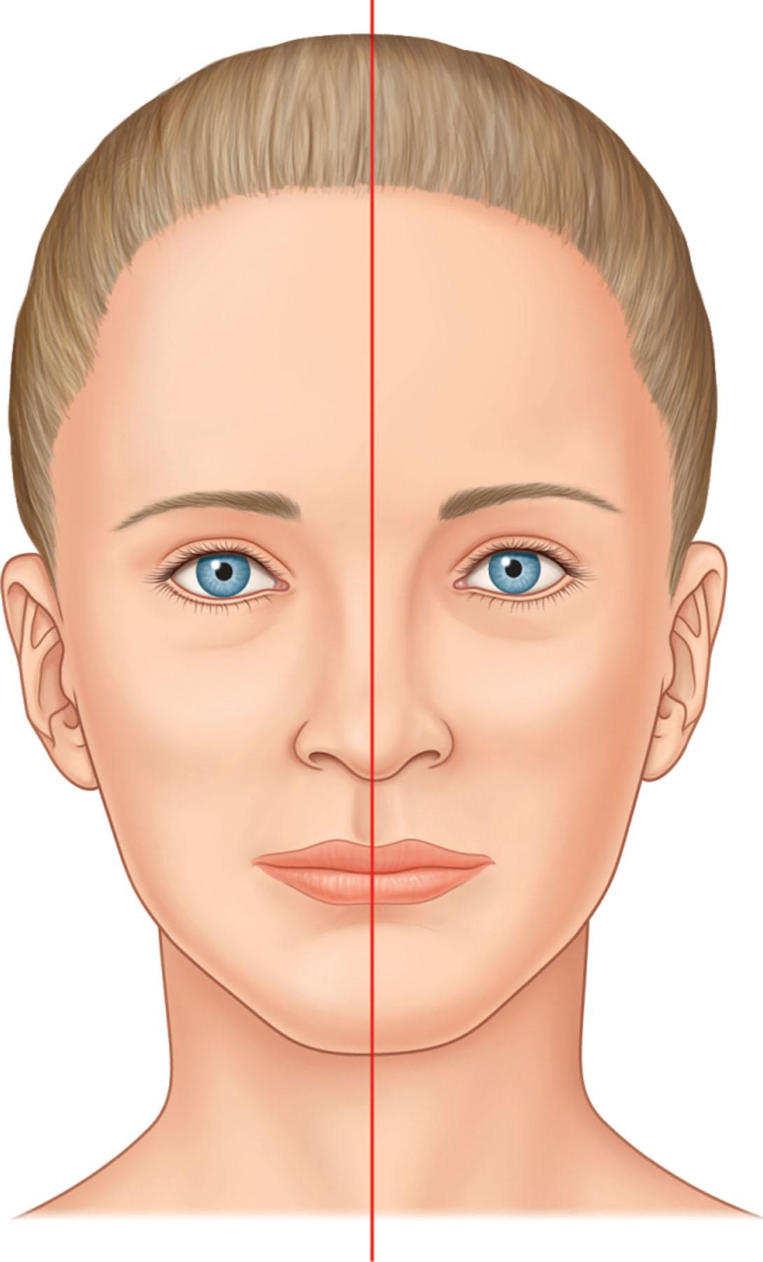 Figure 18.6, A line drawn from midline glabella to menton helps to assess nasal symmetry. This simple method is one of the best means to analyze septal deviation and the position of the nasal bones. It also emphasizes asymmetries of the maxilla or mandible.