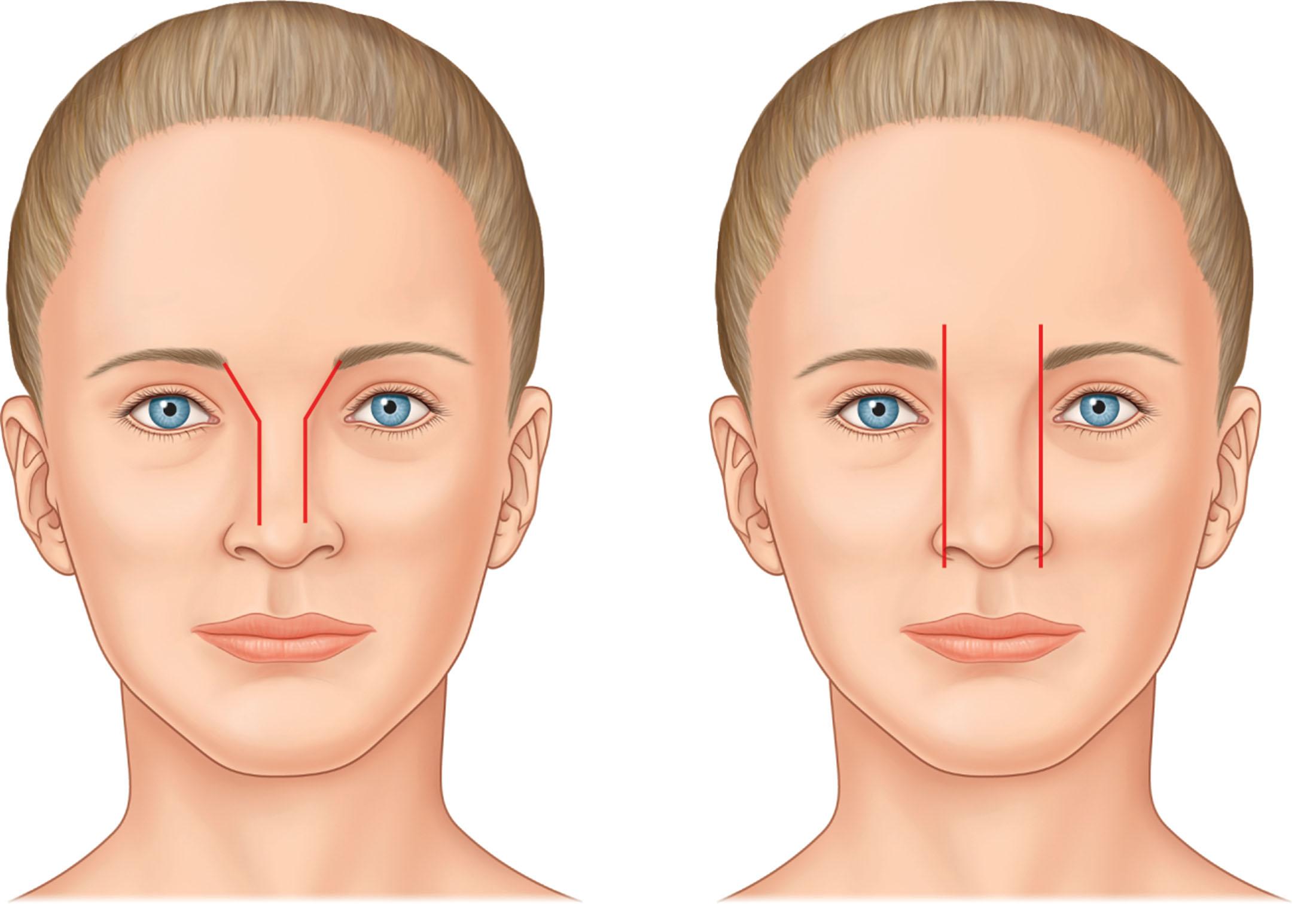 Figure 18.7, The dorsal aesthetic lines should be a gentle curve from brow to tip.